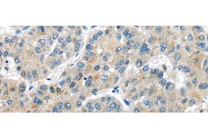 Immunohistochemistry of paraffin-embedded Human liver cancer tissue using MASP2 Polyclonal Antibody at dilution 1:35 (MASP2 Antikörper)
