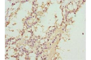 Immunohistochemistry of paraffin-embedded human breast cancer using ABIN7144903 at dilution of 1:100 (ABCC11 Antikörper  (AA 1-170))