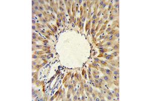 HMGCS2 Antibody (C-term) (ABIN390764 and ABIN2841022) IHC analysis in formalin fixed and paraffin embedded human hepatocarcinoma followed by peroxidase conjugation of the secondary antibody and DAB staining. (HMGCS2 Antikörper  (C-Term))