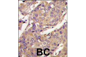Formalin-fixed and paraffin-embedded breast carcinoma tissue reacted with UBE2L6 Antibody , which was peroxidase-conjugated to the secondary antibody, followed by DAB staining. (UBE2L6 Antikörper  (C-Term))