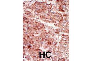 Formalin-fixed and paraffin-embedded human hepatocellular carcinoma tissue reacted with HK3 polyclonal antibody  , which was peroxidase-conjugated to the secondary antibody, followed by AEC staining. (HK3 Antikörper  (C-Term))