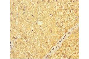 Immunohistochemistry of paraffin-embedded human liver cancer using ABIN7147035 at dilution of 1:100 (CATSPER4 Antikörper  (AA 306-472))