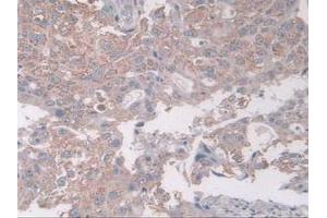 IHC-P analysis of Human Breast Cancer Tissue, with DAB staining. (Coxsackie Adenovirus Receptor Antikörper  (AA 20-229))