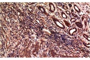 Immunohistochemistry of paraffin-embedded Human breast carcinoma tissue using gamma Tubulin Monoclonal Antibody at dilution of 1:200. (TUBG1 Antikörper)