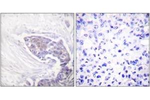Immunohistochemistry analysis of paraffin-embedded human breast carcinoma tissue, using TRXR2 Antibody. (TXNRD2 Antikörper  (AA 471-520))