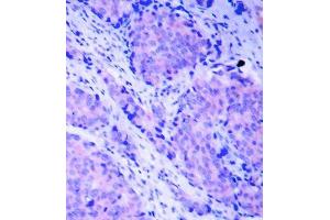 Immunohistochemistry of paraffin-embedded human breast carcinoma tissue, using Phospho-PDPK1-S241 antibody (ABIN2988238). (PDPK1 Antikörper  (pSer241))