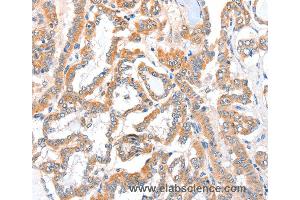 Immunohistochemistry of Human colon cancer using ACSBG1 Polyclonal Antibody at dilution of 1:40