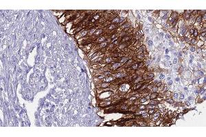 ABIN6268717 at 1/100 staining Human urothelial cancer tissue by IHC-P. (Aquaporin 5 Antikörper  (C-Term))