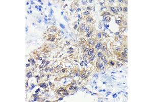 Immunohistochemistry of paraffin-embedded human lung cancer using  antibody (ABIN7265709) at dilution of 1:100 (40x lens). (ATG3 Antikörper)