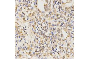 Immunohistochemistry of paraffin-embedded human lung cancer using ATG5 antibody (ABIN4902970) at dilution of 1:100 (40x lens). (ATG5 Antikörper)