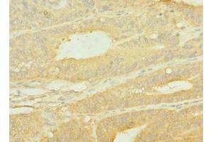 Immunohistochemistry of paraffin-embedded human endometrial cancer using ABIN7156048 at dilution of 1:100 (SLC1A2 Antikörper  (AA 306-348))