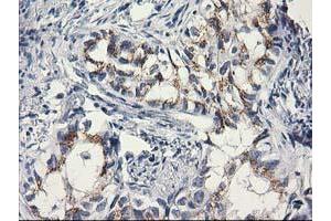 Immunohistochemical staining of paraffin-embedded Carcinoma of Human lung tissue using anti-C1orf50 mouse monoclonal antibody. (C1ORF50 Antikörper)