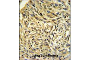 FKBP14 Antibody IHC analysis in formalin fixed and paraffin embedded human Lung carcinoma followed by peroxidase conjugation of the secondary antibody and DAB staining. (FKBP14 Antikörper  (N-Term))