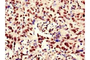 Immunohistochemistry of paraffin-embedded human lung cancer using ABIN7168329 at dilution of 1:100 (RNA Binding Motif Protein, Y Chromosome (RBMY) (AA 501-700) Antikörper)