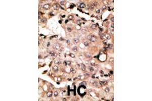 Formalin-fixed and paraffin-embedded human cancer tissue reacted with the primary antibody, which was peroxidase-conjugated to the secondary antibody, followed by DAB staining. (ATG4D Antikörper  (C-Term))