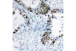 Immunohistochemical analysis of RB1 staining in human colon cancer formalin fixed paraffin embedded tissue section.