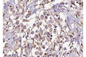 ABIN6277027 at 1/100 staining Human breast cancer tissue by IHC-P. (EXT1 Antikörper)
