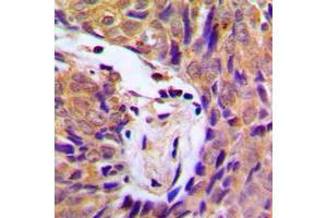 Immunohistochemical analysis of IKK alpha/beta (pS180/181) staining in human breast cancer formalin fixed paraffin embedded tissue section. (IKK-alpha /IKK-beta Antikörper  (pSer180, pSer181))