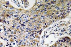 Immunohistochemistry (IHC) analyzes of ATP5J2 antibody in paraffin-embedded human lung carcinoma tissue. (ATP5J2 Antikörper  (Subunit F))