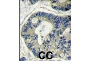 Formalin-fixed and paraffin-embedded human colon carcinoma reacted with AKT2 Antibody (N-term) (ABIN391021 and ABIN2841191) , which was peroxidase-conjugated to the secondary antibody, followed by DAB staining.