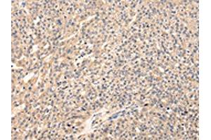 The image on the left is immunohistochemistry of paraffin-embedded Human breast cancer tissue using ABIN7128083(VIP Antibody) at dilution 1/20, on the right is treated with fusion protein.