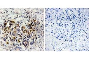 Peptide - +Immunohistochemistry analysis of paraffin-embedded human breast carcinoma tissue, using IRX3 antibody. (IRX3 Antikörper)