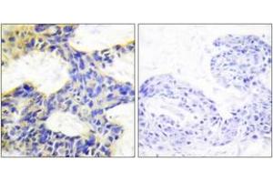 Immunohistochemistry analysis of paraffin-embedded human breast carcinoma tissue, using S6K Antibody.