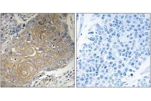 Immunohistochemistry analysis of paraffin-embedded human lung carcinoma tissue, using MRPS33 Antibody. (MRPS33 Antikörper  (AA 51-100))