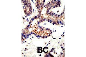 Formalin-fixed and paraffin-embedded human cancer tissue reacted with UBQLN3 polyclonal antibody  , which was peroxidase-conjugated to the secondary antibody, followed by DAB staining . (Ubiquilin 3 Antikörper  (N-Term))