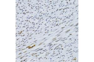 Immunohistochemistry of paraffin-embedded human uterine cancer using SNRNP70 antibody. (SNRNP70 Antikörper  (AA 150-250))