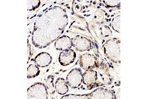 Immunohistochemistry of paraffin embedded human gastric cancer using ANKK1 (ABIN7073056) at dilution of 1:200 (400x lens) (ANKK1 Antikörper)