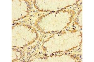 Immunohistochemistry of paraffin-embedded human colon cancer using ABIN7173655 at dilution of 1:100 (TUBA1B Antikörper  (AA 29-310))