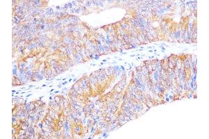 Immunohistochemistry of paraffin-embedded human colon carcinoma using Cyclophilin 40 Rabbit mAb (ABIN7269213) at dilution of 1:100 (40x lens). (PPID Antikörper)