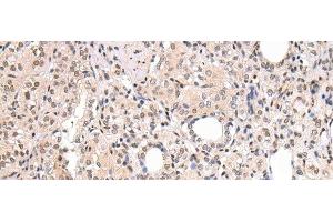 Immunohistochemistry of paraffin-embedded Human thyroid cancer using CBX7 Polyclonal Antibody at dilution of 1/20