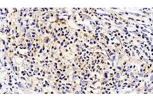 Detection of IL5Ra in Human Stomach cancer Tissue using Polyclonal Antibody to Interleukin 5 Receptor Alpha (IL5Ra) (IL5RA Antikörper  (AA 42-182))