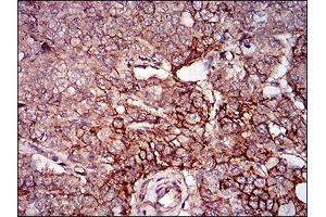Immunohistochemical analysis of paraffin-embedded prostate cancer tissues using mSplunc2 mouse mAb with DAB staining. (BPIFA2 Antikörper  (AA 16-169))
