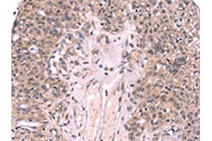 The image on the left is immunohistochemistry of paraffin-embedded Human ovarian cancer tissue using ABIN7190608(EXTL1 Antibody) at dilution 1/20, on the right is treated with synthetic peptide. (EXTL1 Antikörper)