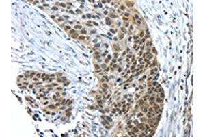 The image on the left is immunohistochemistry of paraffin-embedded Human esophagus cancer tissue using (TKTL1 Antibody) at dilution 1/40, on the right is treated with fusion protein. (TKTL1 Antikörper)
