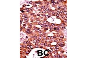 Formalin-fixed and paraffin-embedded human cancer tissue reacted with CDC6 (phospho S54) polyclonal antibody  which was peroxidase-conjugated to the secondary antibody followed by AEC staining. (CDC6 Antikörper  (pSer54))