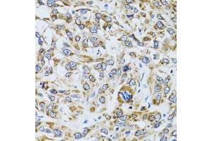 Immunohistochemistry of paraffin-embedded human liver cancer using RPN1 antibody.