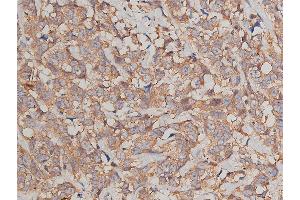 ABIN6269036 at 1/200 staining human breast cancer tissue sections by IHC-P. (JUP Antikörper  (C-Term))