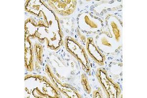 Immunohistochemistry of paraffin-embedded human kidney cancer using GLRX Antibody (ABIN1876503) at dilution of 1:200 (40x lens). (Glutaredoxin 1 Antikörper)