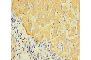 Immunohistochemistry of paraffin-embedded human liver cancer using ABIN7158796 at dilution of 1:100 (LAPTM5 Antikörper  (AA 205-262))