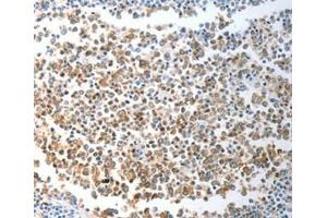 Immunohistochemical analysis of paraffin-embedded Human liver cancer tissue using at dilution 1/40. (CHD5 Antikörper  (C-Term))
