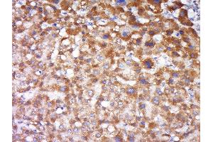Formalin-fixed and paraffin embedded human liver carcinoma labeled with Anti-FAIM3 Polyclonal Antibody, Unconjugated  at 1:500 followed by conjugation to the secondary antibody and DAB staining. (FAIM3 Antikörper  (AA 51-150))