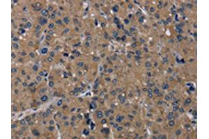 The image on the left is immunohistochemistry of paraffin-embedded Human liver cancer tissue using ABIN7192919(TRPM1 Antibody) at dilution 1/20, on the right is treated with synthetic peptide. (TRPM1 Antikörper)