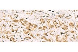 Immunohistochemistry of paraffin-embedded Human gastric cancer tissue using PDS5A Polyclonal Antibody at dilution of 1:90(x200) (PDS5A Antikörper)