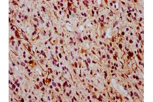 IHC image of ABIN7127707 diluted at 1:100 and staining in paraffin-embedded human glioma cancer performed on a Leica BondTM system. (Rekombinanter ERK1 Antikörper  (pThr185, pThr202))