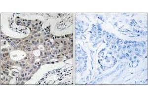 Immunohistochemistry analysis of paraffin-embedded human breast carcinoma, using SEC16A Antibody. (SEC16A Antikörper  (AA 1013-1062))