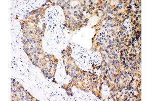 Anti-Caspase-12 antibody, IHC(P) IHC(P): Human Mammary Cancer Tissue (Caspase 12 Antikörper  (N-Term))